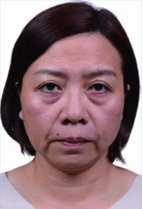 術前 皮膚老化之後,會顯得鬆垮、下垂,整個人看來疲累不堪。業者提供