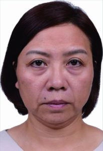 第一階段 施打玻尿酸於蘋果肌、夫妻宮,除了具有拉提效果,同時也為皮膚質感打下地基,共注射4c.c.玻尿酸,花費約8萬元。業者提供
